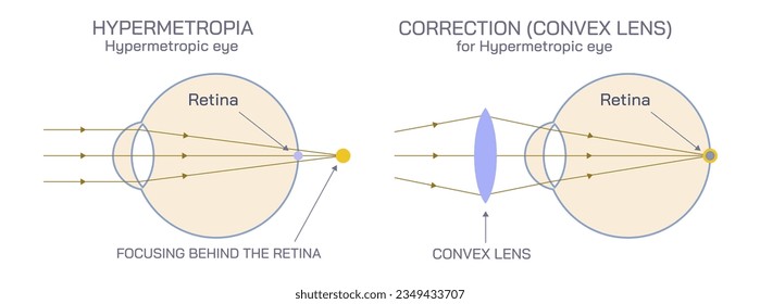 Difference between Hyperopia and myopia. The distant object becomes focused behind or in front of the retina. Making close or distant objects appear out of focus.