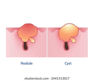 The difference between nodule and cyst vector on white background. Nodular is firm, painful, red bump on the surface skin. Cystic acne consist of deep, pus filled. The both are inflammatory severe.