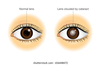 Difference Between Normal Eye Lens Clouded Stock Vector (Royalty Free ...