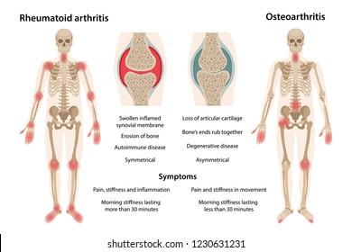 The difference between rheumatoid arthritis and osteoarthritis. On the body, arthritic sites are marked. Images of joints affected by rheumatoid arthritis and osteoarthritis. Vector illustration