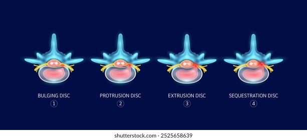 Diferencia entre las etapas de la hernia discal. Protuberancia, Protrusión, Extrusión y Secuestro. Problemas de la columna vertebral que causan dolor de espalda y cuello. Concepto médico. Ilustración vectorial.