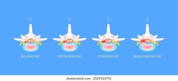 Diferencia entre las etapas de la hernia discal. Protuberancia, Protrusión, Extrusión y Secuestro. Problemas de la columna vertebral que causan dolor de espalda y cuello. Concepto médico. Ilustración vectorial.