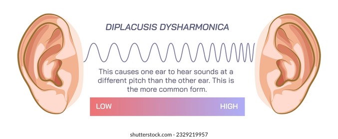 Difference between two ears, double hearing, density or pressure of sound, different frequency, compression, diplacusis dysharmonica and echoica. travelling sound wave, Dysharmonica and echoica. sound