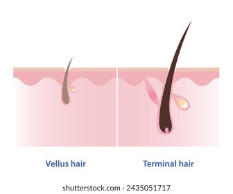 La diferencia entre el vello y el vector de pelo terminal sobre fondo blanco. Tipos de cabello. El vello es fino, delgado y sin pigmentación. El pelo terminal es grueso, grueso, largo y pigmentado.