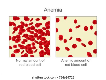 3,531 Red blood cell abnormalities Images, Stock Photos & Vectors ...