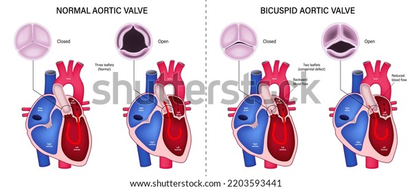 The difference of normal\
aortic valve and bicuspid aortic valve. Valvular aortic stenosis.\
Heart anatomy vector. Close-up of normal and abnormal aortic\
valves.