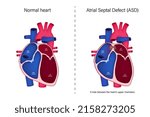The difference of normal heart and atrial septal defect  vector. Congenital heart defect.