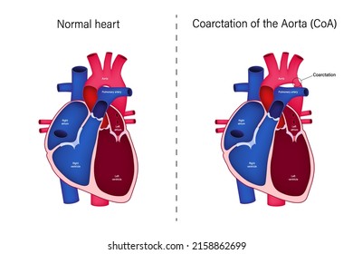 The Difference Of Normal Heart And Coarctation Of The Aorta Vector. Congenital Heart Disease. 