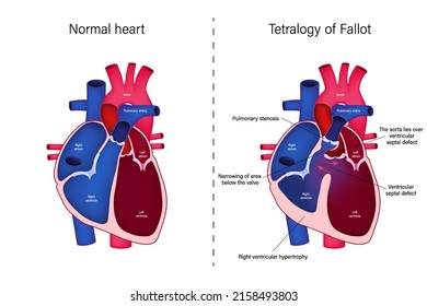 Difference Normal Heart Tetralogy Fallot Vector Stock Vector (Royalty ...