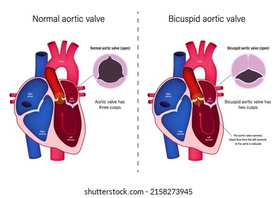 The difference of normal heart valve and bicuspid aortic valve vector. Congenital heart disease. Aortic valve stenosis.