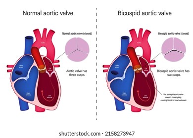 The difference of normal heart valve and bicuspid aortic valve vector. Congenital heart disease. Aortic valve regurgitation.