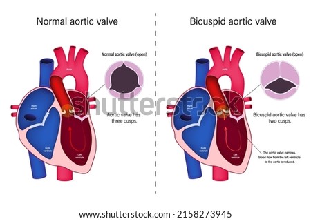 The difference of normal heart valve and bicuspid aortic valve vector. Congenital heart disease. Aortic valve stenosis.