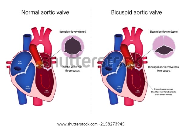 The\
difference of normal heart valve and bicuspid aortic valve vector.\
Congenital heart disease. Aortic valve\
stenosis.