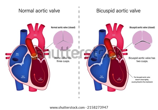 The\
difference of normal heart valve and bicuspid aortic valve vector.\
Congenital heart disease. Aortic valve\
regurgitation.