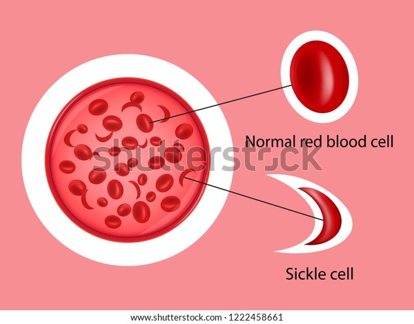 Difference Normal Red Blood Cells Sickle Stock Vector (Royalty Free ...