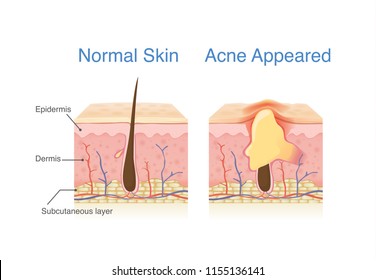 Difference Of Normal Skin Layer And Skin Layer With Acne. Illustration About Dermatology Diagram.