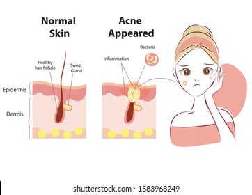 Difference of Normal skin layer and skin layer with Acne. Illustration about dermatology diagram. Beauty cartoon illustration