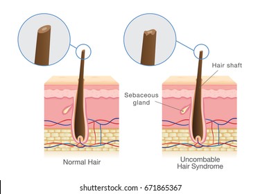 The difference of shaft of normal hair and Uncombable hair syndrome. Illustration about medical diagram.