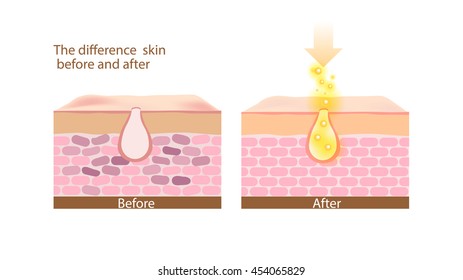 A diferença skin antes e depois do vetor