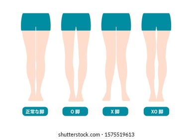 Difference types of  legs angles and knees vector illustration (Japanese) . translation: Normal, Bowlegs, Knock-knees, Mix types.