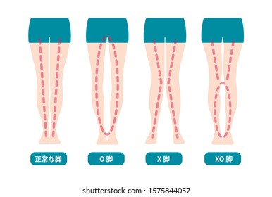 Difference types of  legs angles and knees vector illustration (Japanese) . translation: Normal, Bowlegs, Knock-knees, Mix types.