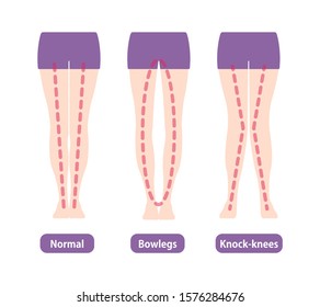 Difference types of  legs angles and knees vector illustration . Normal, Bowlegs, Knock-knees.