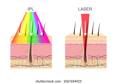 The difference of using IPL light and laser in hair removal. Illustration about beauty technology.