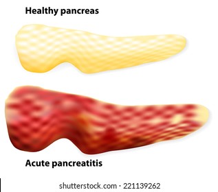 The differences between healthy pancreas and inflamed pancreas (pancreatitis). Human anatomy. Vector diagram. 