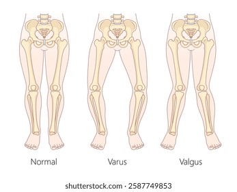 differences between normal leg alignment, varus bowlegged, and valgus knock-knees conditions with skeletal structure diagram hand drawn vector illustration. Medical science educational illustration