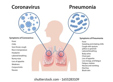 Unterschiede zwischen den Symptomen von Lungenentzündung und Coronavirus. Lungenentzündungssymptome. Symptome von 2019-nCoV. Vektorillustration auf flachem Hintergrund einzeln auf weißem Hintergrund