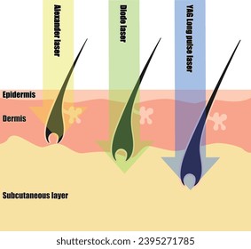 Differences in hair removal lasers seen in cross-sectional views of the skin