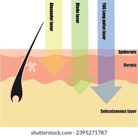 Differences in hair removal lasers seen in cross-sectional views of the skin