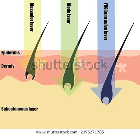 Differences in hair removal lasers seen in cross-sectional views of the skin
