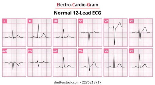 Las diferencias en la forma de onda ECG normal para cada uno de los 12 principales ECG estándar - Vectores médicos e ilustraciones para fines médicos