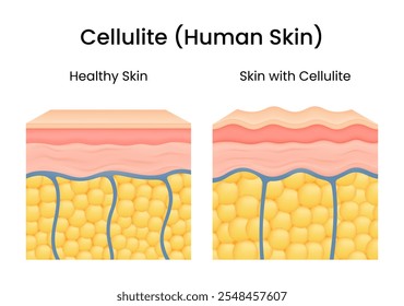 Diferenças na estrutura da pele entre pele saudável e pele com celulite