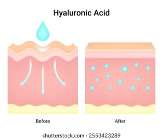 Differences in Use of Hyaluronic Acid Before and After