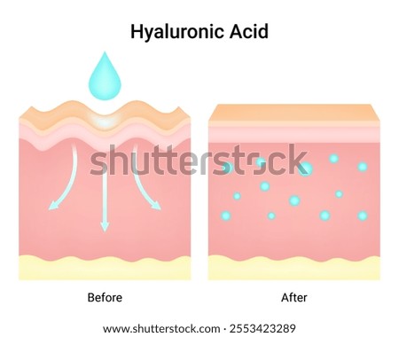 Differences in Use of Hyaluronic Acid Before and After