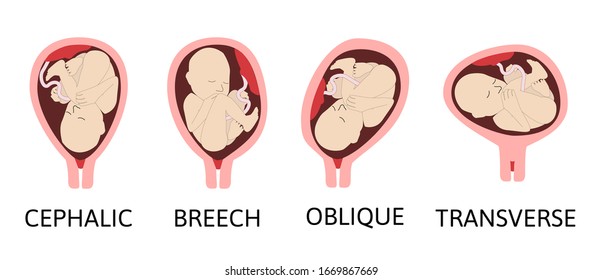 Different baby positions in the uterus during pregnancy. Cephalic, Breech, transverse, Oblique lies. Colored medical vector illustration. Fetus with umbilical cord and placenta.

