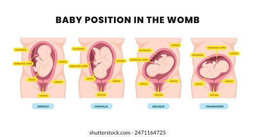 Diferentes posiciones del bebé en el útero durante el embarazo, Cefálica, de nalgas, transversal, Oblicua se encuentra. Anuncio de póster médico coloreado. Feto con cordón umbilical y placenta