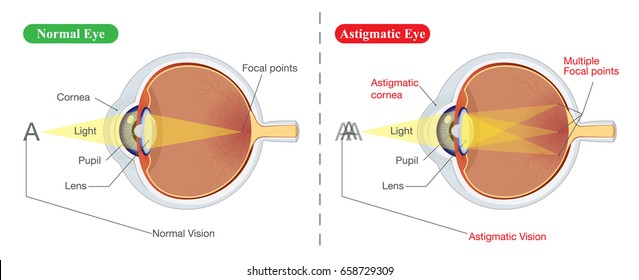 The different between vision of normal eye and Astigmatic. Illustration about common eye problem.