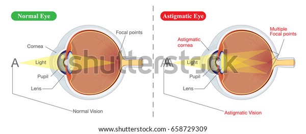 The different between vision of
normal eye and Astigmatic. Illustration about common eye
problem.