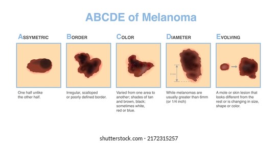 Different characteristics of skin damage. ABCDE stands for asymmetry, border, color, diameter, and evolving. Medical diagram for diagnosing and classifying melanomas and treatment.