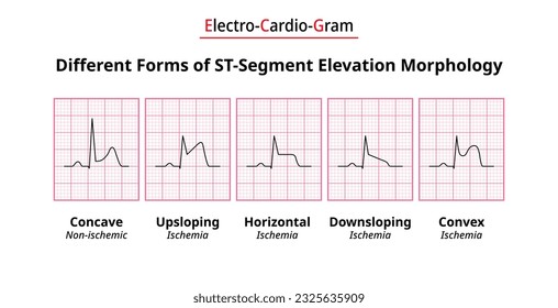 Different Forms of ST-Segment Elevation Morphology - ECG Ischemia - Non ischemic - Electrocardiography Vector Medical Illustration