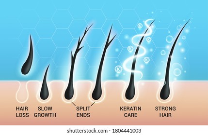 Different hair problems and deep salon treatment vector illustrations set, macro view of balding scalp skin and follicles.