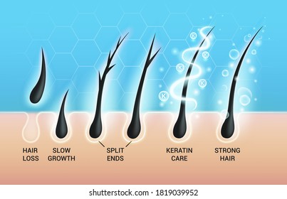 Different hair problems and deep salon treatment vector illustrations set, macro view of balding scalp skin and follicles.