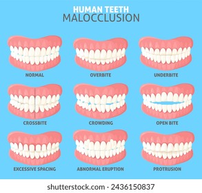 Diferentes tipos de maloclusión de dientes humanos conjunto ilustración vectorial. Cartel médico con las mandíbulas de las personas con oclusión normal y anormal vista frontal