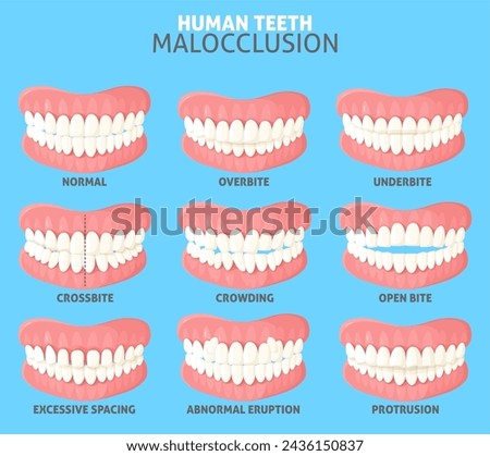 Different human teeth malocclusion types set vector illustration. Medical poster with people mouth jaws with normal and abnormal occlusion front view