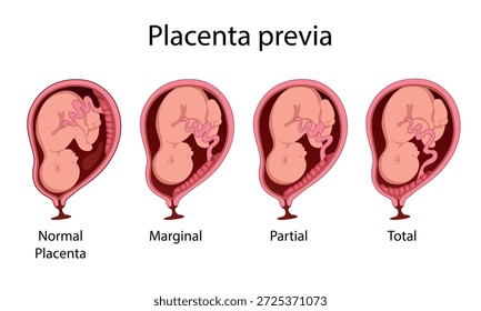 Different location of the Placenta during Pregnancy. Major, normal, total and partial placenta previa. Pathology. vector illustration.
