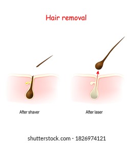 different methods of hair removal. cross section of the Hair and skin after shaving or wax, and after laser hair removal. depilatory and epilator. vector illustration