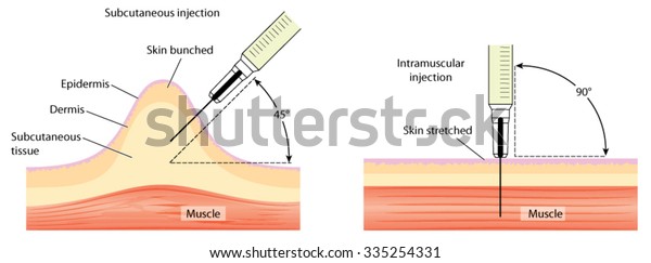 Different methods for\
injecting the skin and the muscle, showing skin bunching and skin\
stretching.